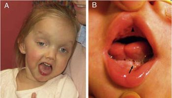 Joubert syndrome