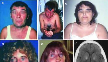 MELAS Syndrome