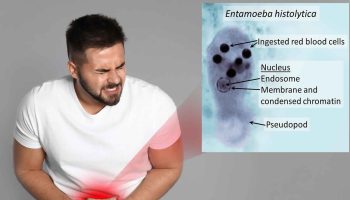 amebiasis
