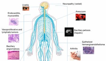 Bartonellosis