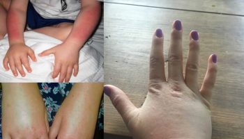 X-linked protoporphyria