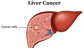 liver-cancer
