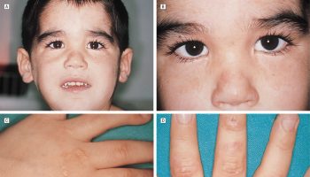 hepatoerythropoietic porphyria